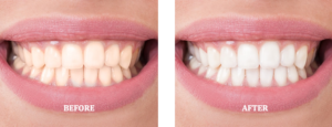 before-after-generic-1 before-after-generic-1